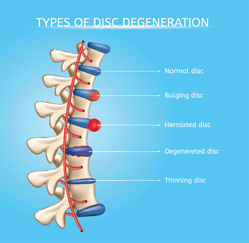 What Causes Herniated Discs?